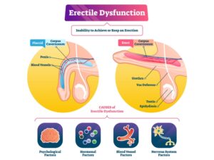 Erectile Dysfunction Diabetes Ghaziabad